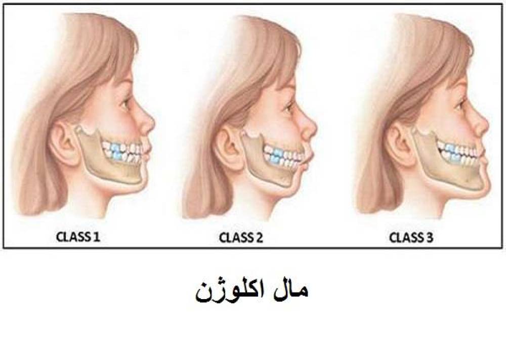 مال اکلوژن دندانی یا فکی