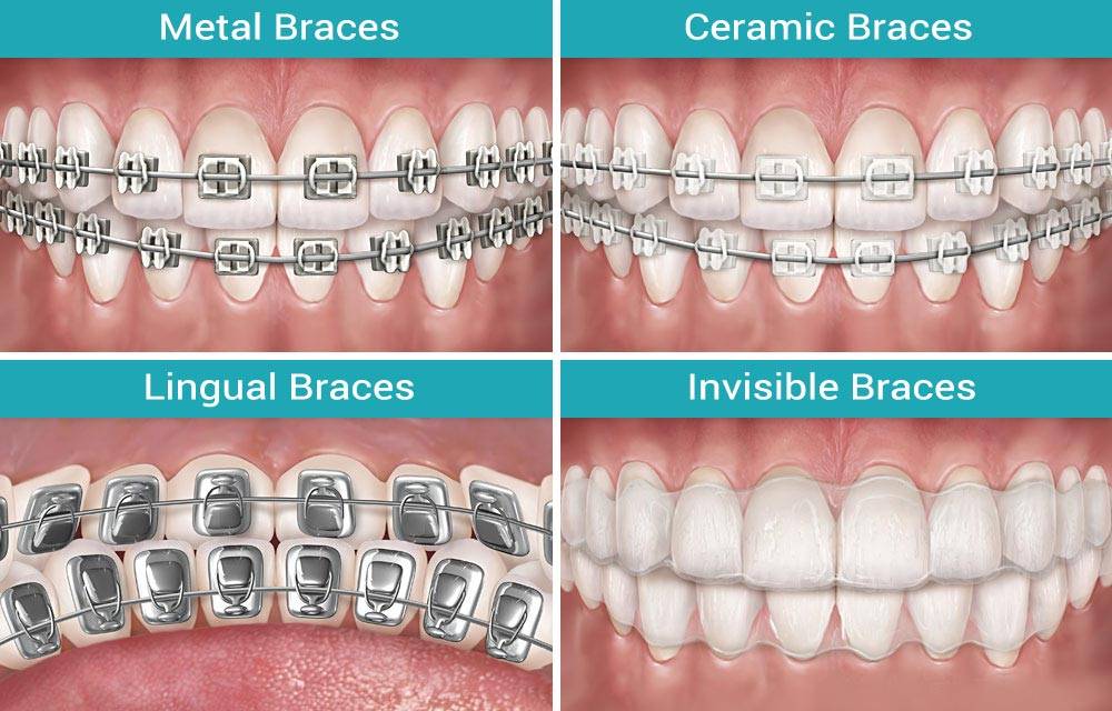  کدام یک از انواع مختلف ارتودنسی برای من مناسب است؟