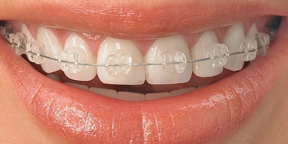 ارتودنسی نامرئی در صباشهر
