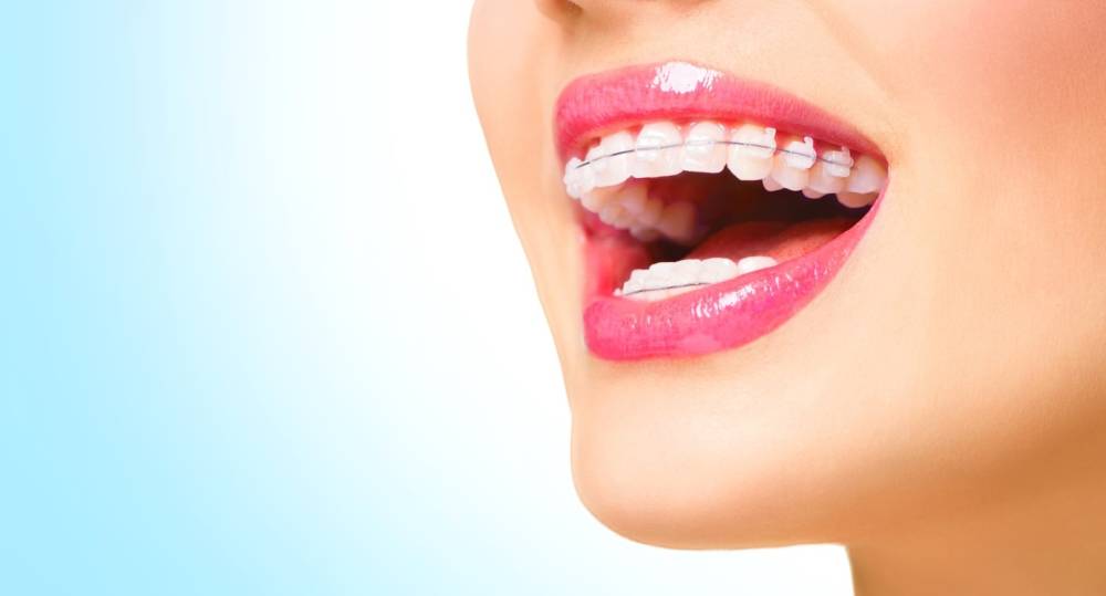ارتودنسی با براکت شفاف: چه کسانی میتوانند از آن استفاده کنند؟