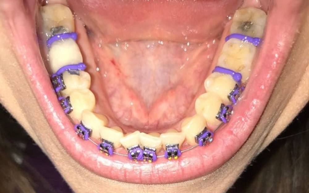آشنایی با استریپینگ یا سایش بین دندانی طی درمان با ارتودنسی نامریی